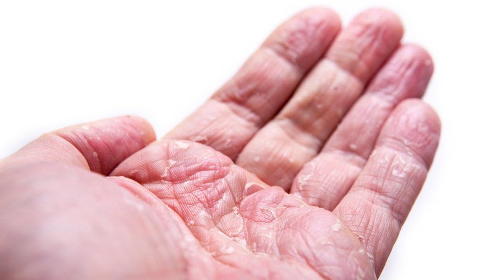 Hand with eczema