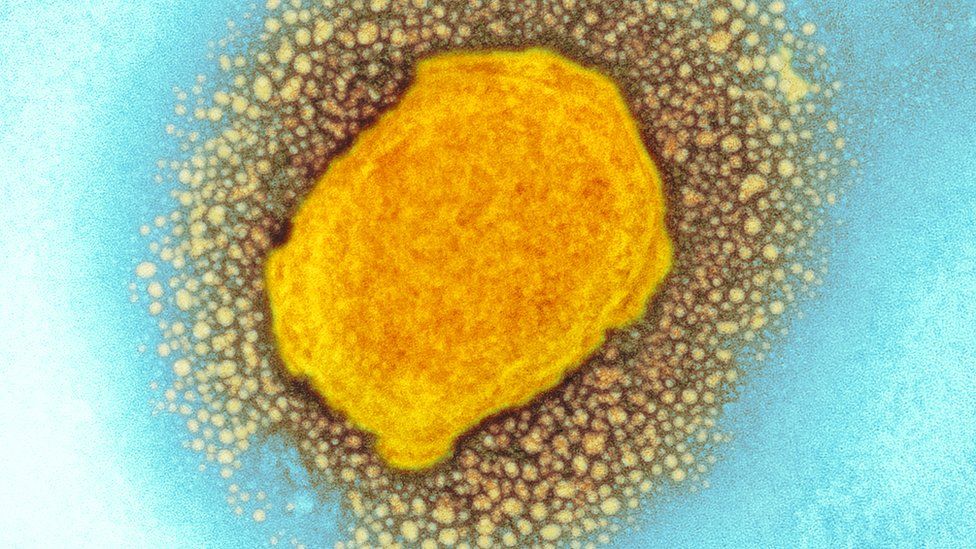 Monkeypox virus particle, TEM: Monkeypox virus particle, coloured transmission electron micrograph (TEM)