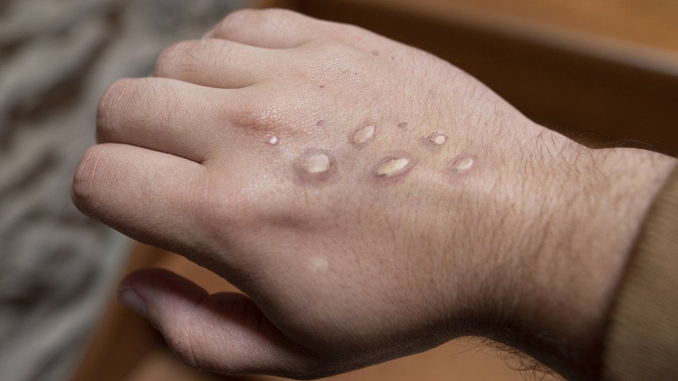 Monkeypox rash on a hand (file picture)