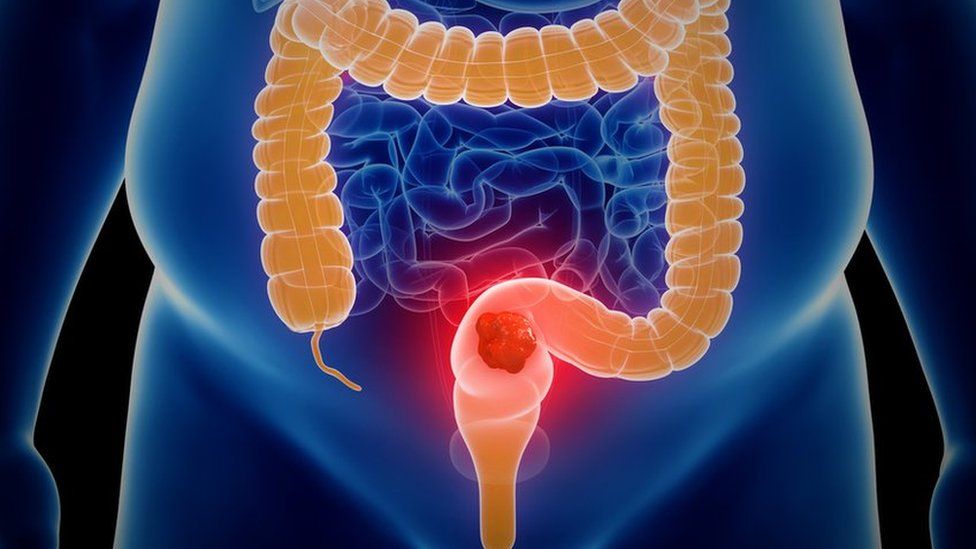 Where the bowel is in the body