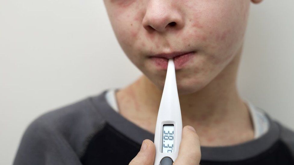A boy with a measles rash taking his temperature