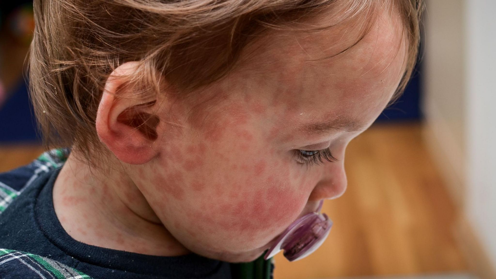 A toddler with a measles rash on the face and neck
